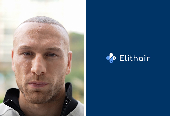 -jour-après-greffe-de-cheveux-dhi-4000-greffons-kerim-engizek