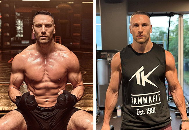 Photo résultat greffe de cheveux dhi 4000 greffons kerim engizek