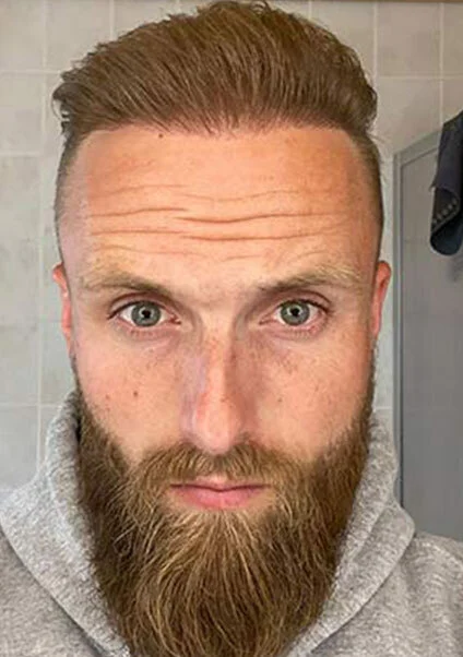 Photo montrant le résultat de la greffe de cheveux de Frederik, effectuée avec Elithair