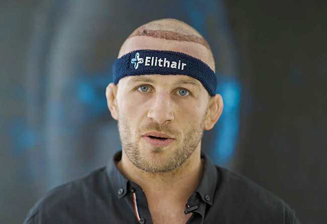 Photo 1 jour après greffe DHI 5700 greffons Stephan Pütz