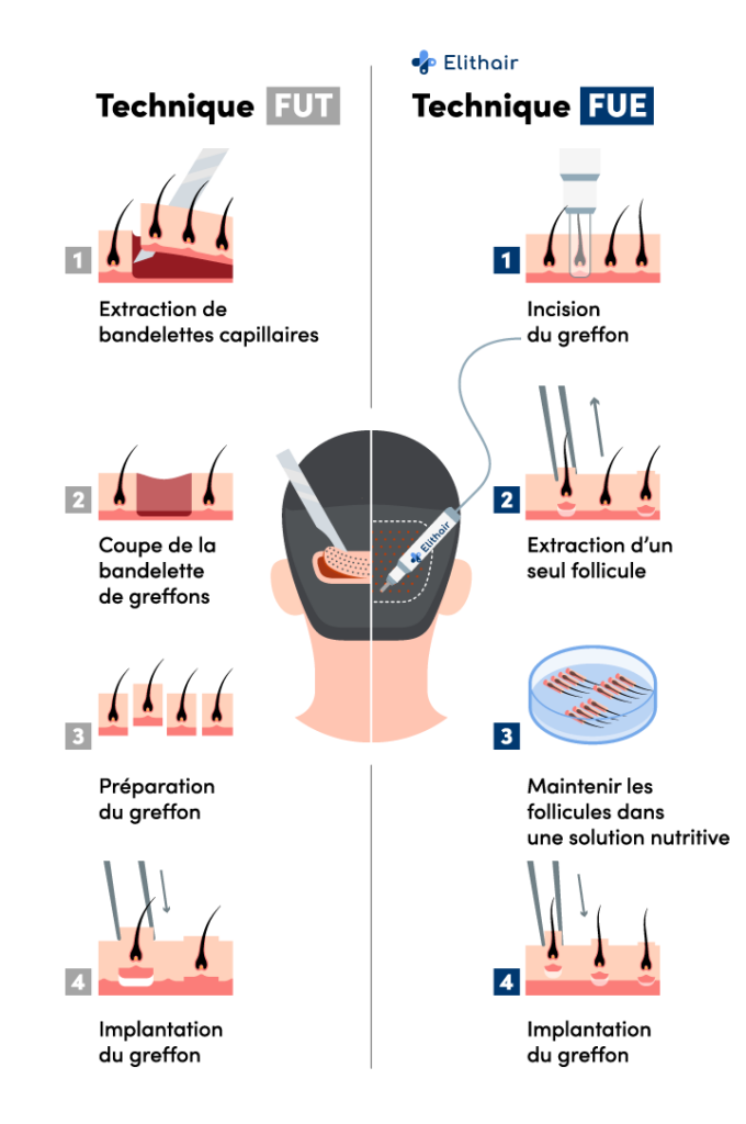 inforgraphie montrant les différences entre les techniques de greffe de cheveux FUE et FUT