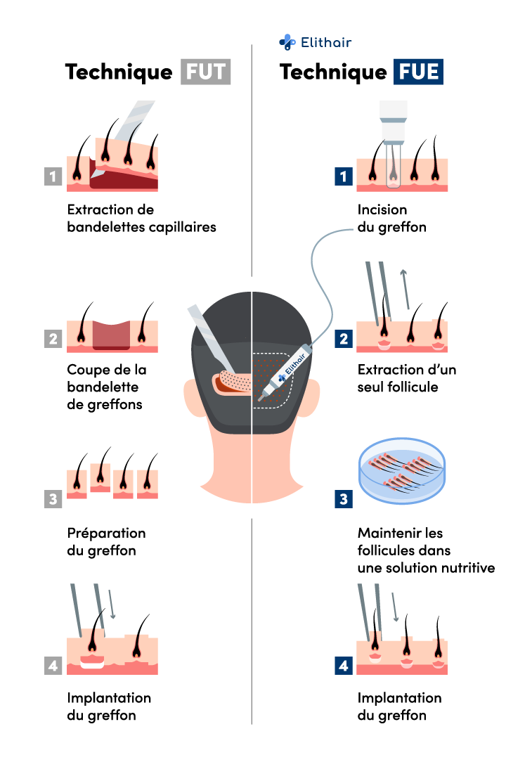 inforgraphie montrant les différences entre les techniques de greffe de cheveux FUE et FUT