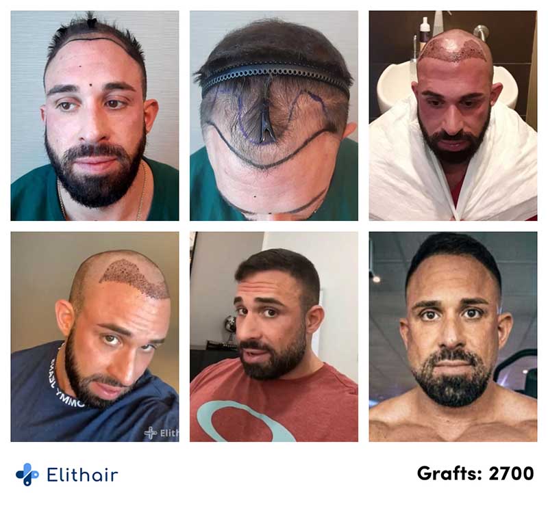 avant-apres-greffe-de-cheveux-2700-greffons-kevin-w