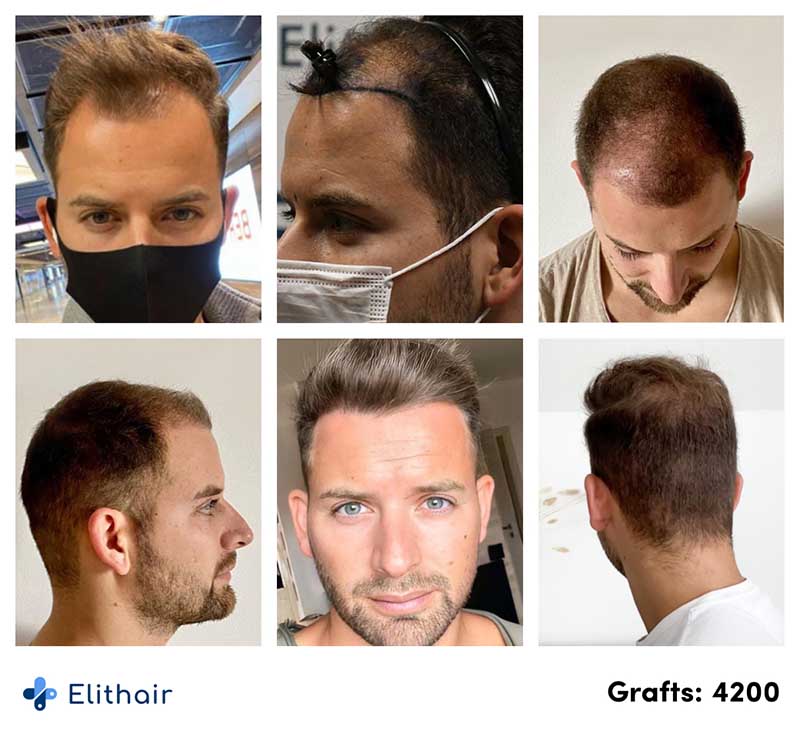 avant-apres-greffe-de-cheveux-4200-greffons-marcel-o-elithair