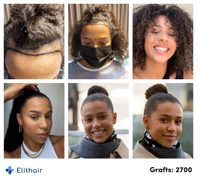 photos avant aprés de la greffe de cheveux pour femme de la patiente Melissa effectuée avec 2700 greffons à la clinique Elithair