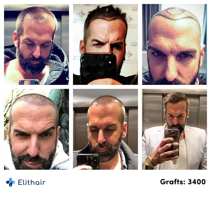 avant-apres-greffe-de-cheveux-fue-juergen-3400-greffons-elithair
