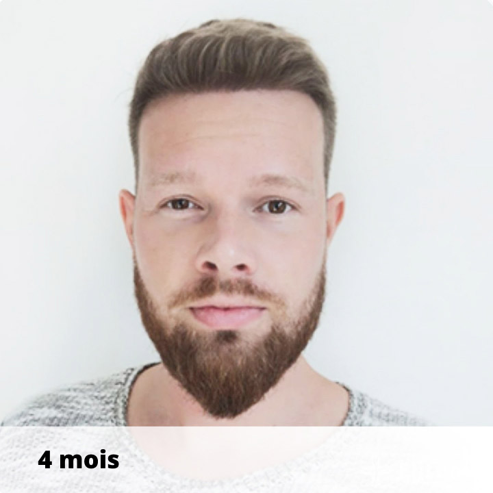 patient-apres-greffe-de-cheveux-elithair-août