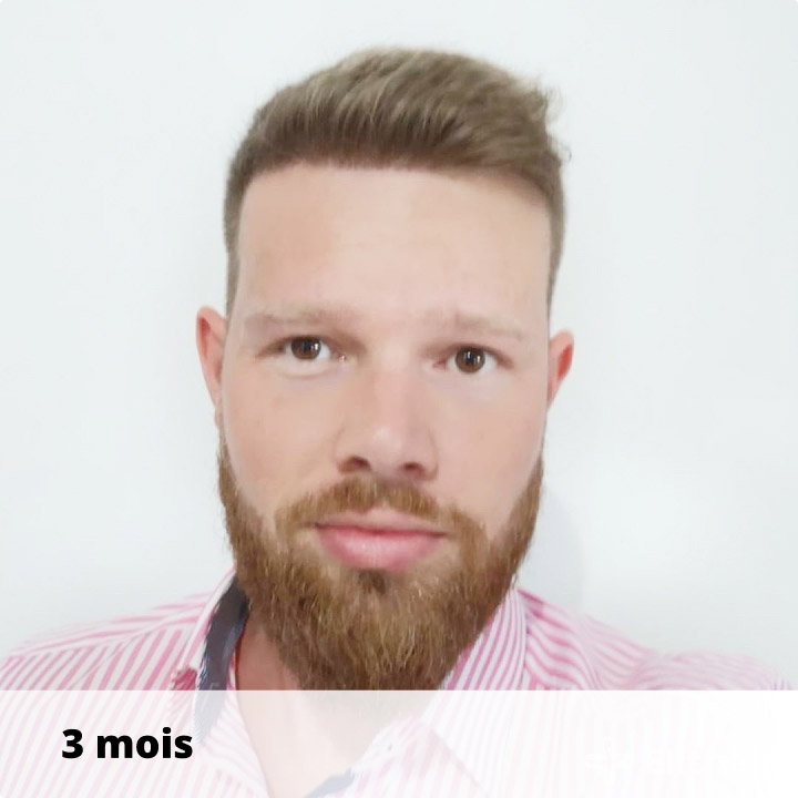 patient-apres-greffe-de-cheveux-elithair-juillet