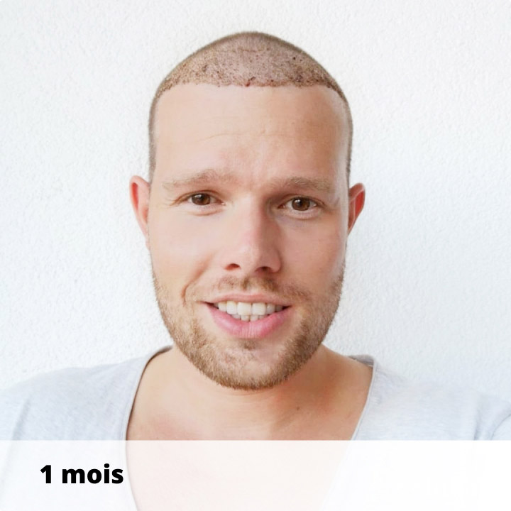 patient-apres-greffe-de-cheveux-elithair-mai