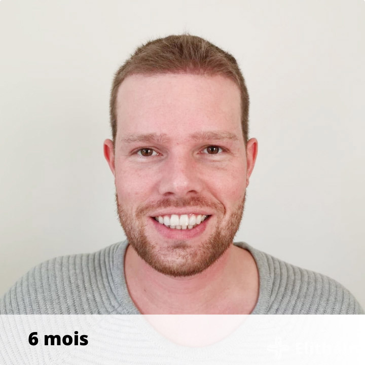 patient-apres-greffe-de-cheveux-elithair-octobre
