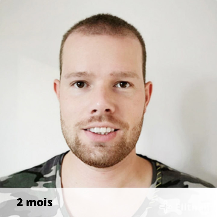 patient-apres-greffe-de-cheveux-elithair-septembre-juin