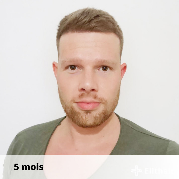 patient-apres-greffe-de-cheveux-elithair-septembre