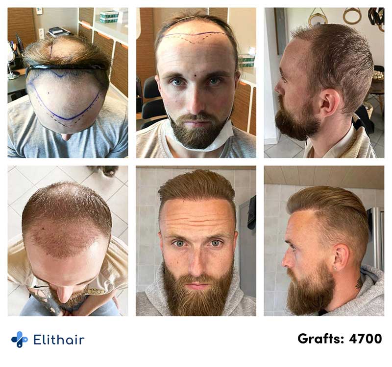 Photo avant après greffe de cheveux Elithair Frederik