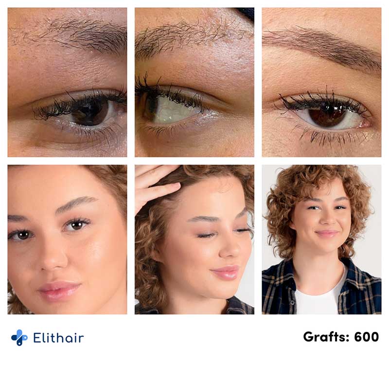 resultat-avant-apres-implant-sourcil-elithair-Lilianna-600-greffons-elithair