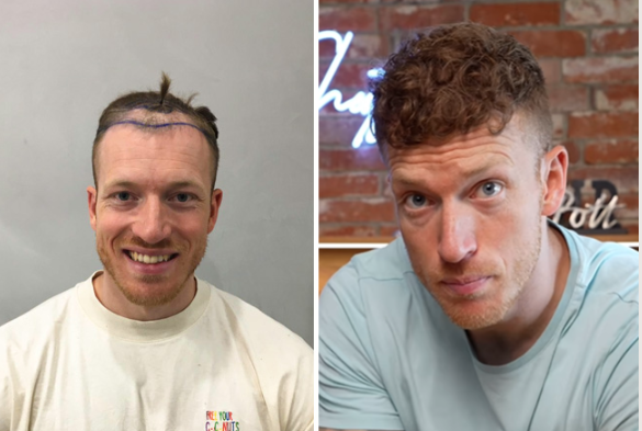 Le résultat d'un patient Elithair avant et après sa greffe de cheveux en Turquie