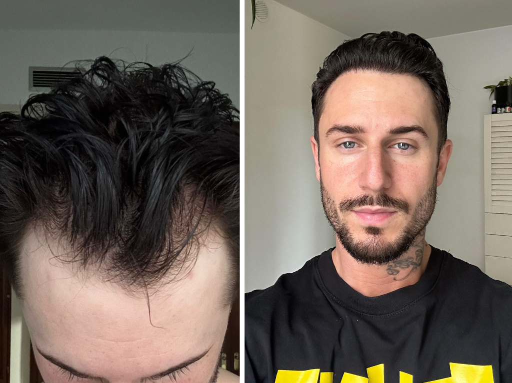 La correction d'une calvitie via une greffe de cheveux avec la clinique Elithair