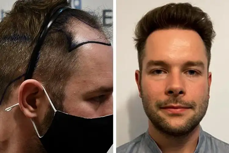 Résultat du patient Elithair Michael S. avant et après son implant capillaire