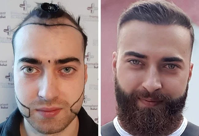 Photo André de son résultat avant et après son implant capillaire et barbe chez Elithair