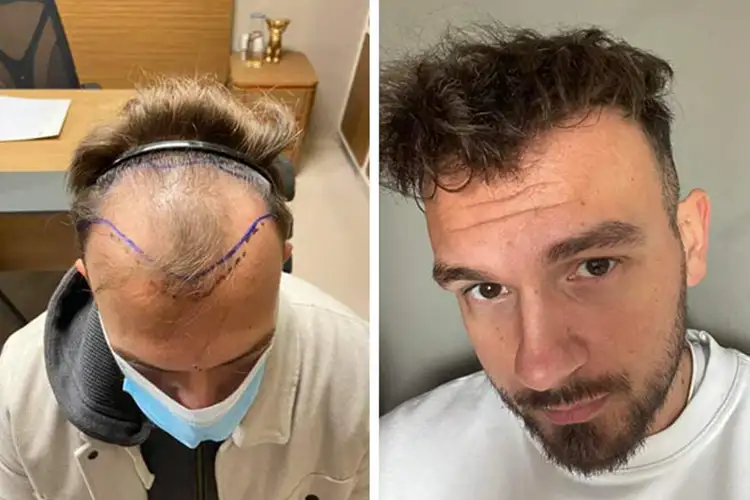 Homme retrouvant sa chevelure avant et après son implant capillaire à la clinique Elithair