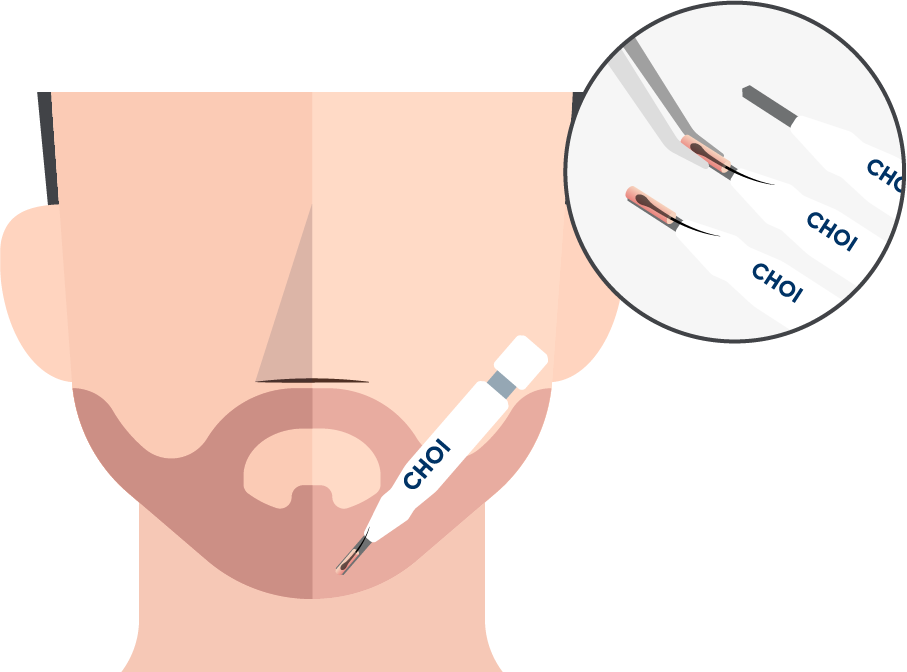 Illustration de l'insertion des greffons avec la technique DHI pour une greffe de barbe