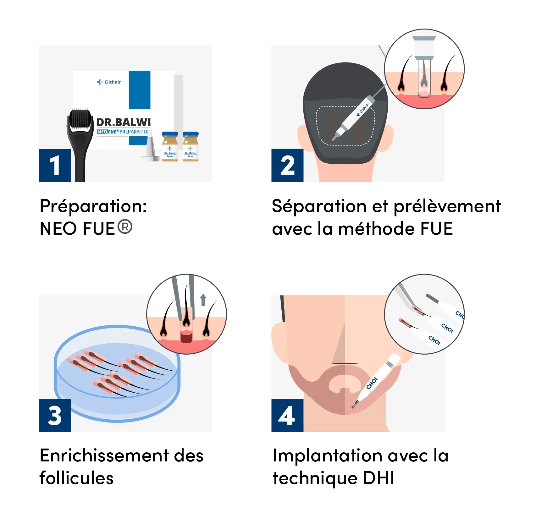 Schéma des étapes de la greffe de barbe chez Elithair.