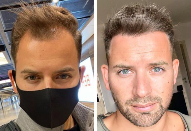 Résultat avant-après greffe de cheveux Marcel