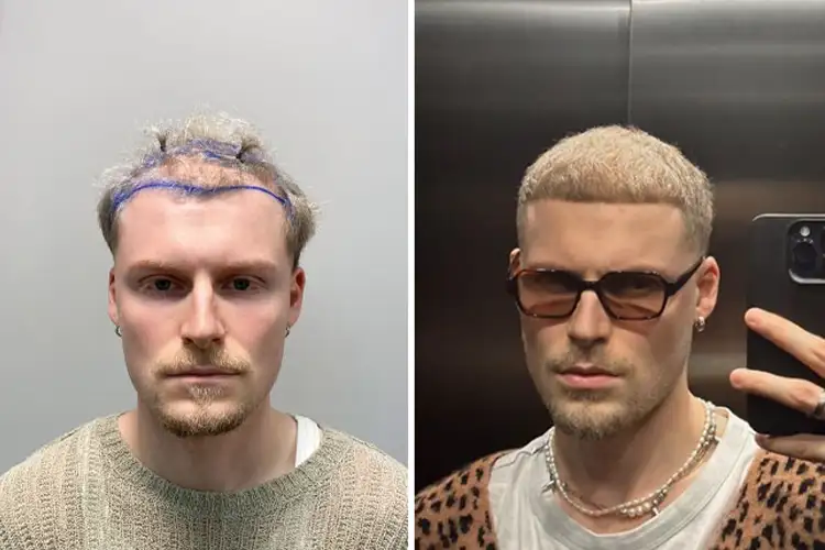 Transformation capillaire après une greffe Elithair d'un de nos patients