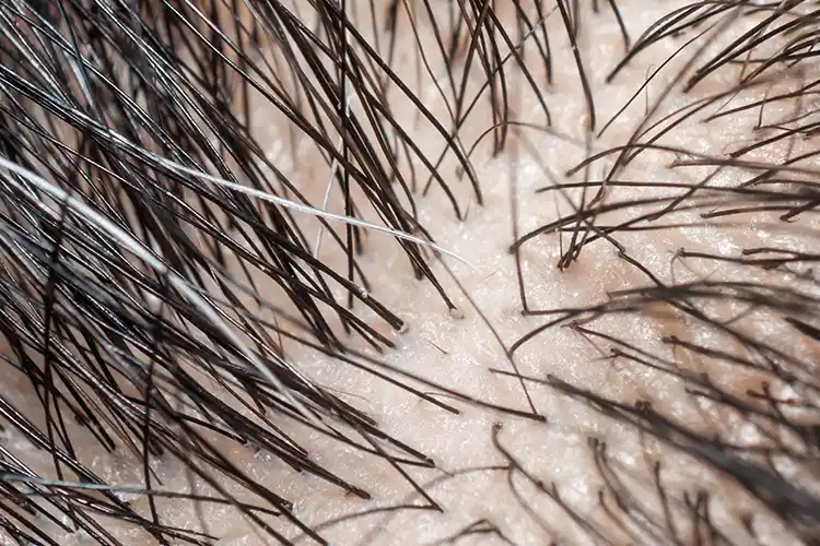 Détail de la croissance des follicules pileux sur le cuir chevelu