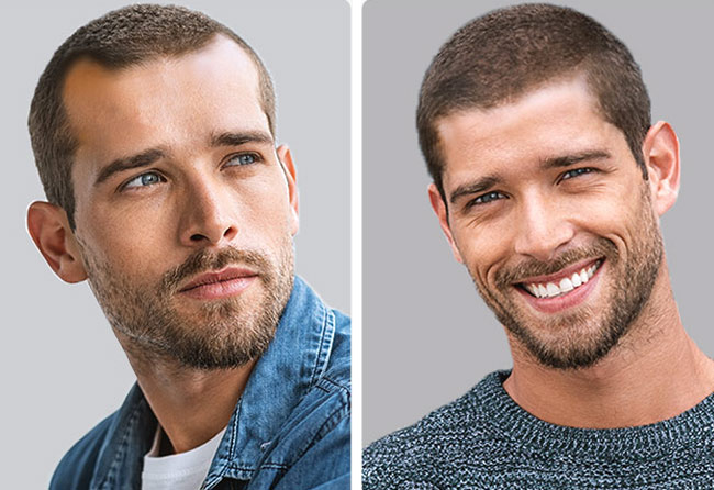 Patient avant-après traitement PRP chez Elithair