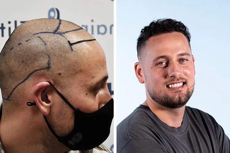 Comparaison visuelle illustrant le résultat d’une greffe de cheveux réalisée chez Elithair