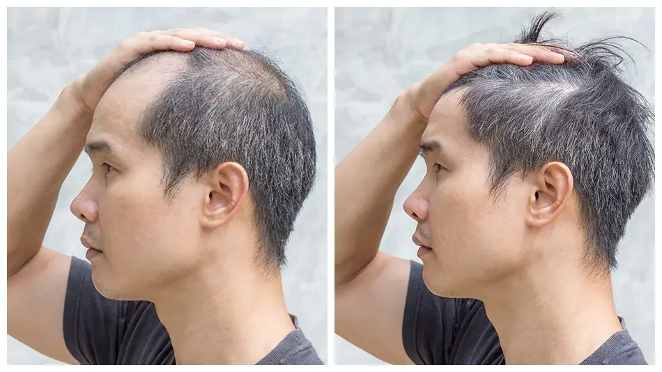 Un homme asiatique vu de profil avec des signes de perte de cheveux