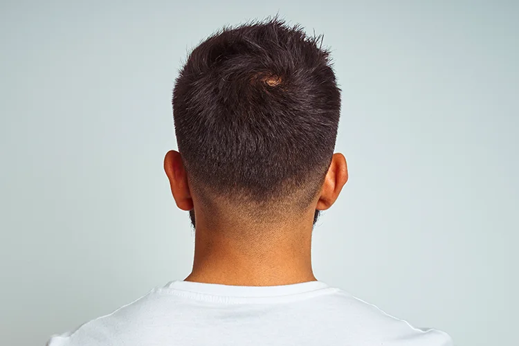 Vue arrière d'un homme montrant la zone donneuse au niveau de l'arrière de la tête pour une greffe de cheveux.
