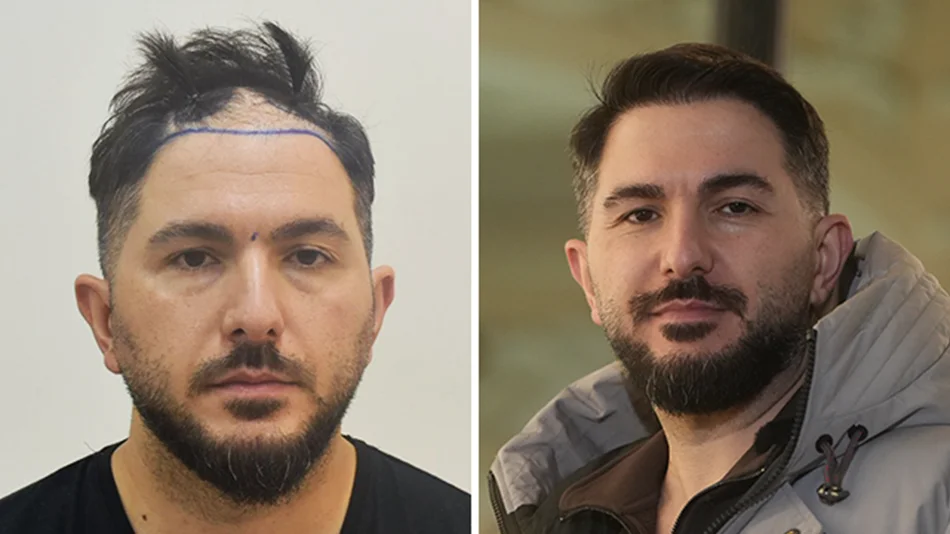 Résultat avant après d’une greffe de cheveux DHI avec 4200 greffons chez le patient Onur Y