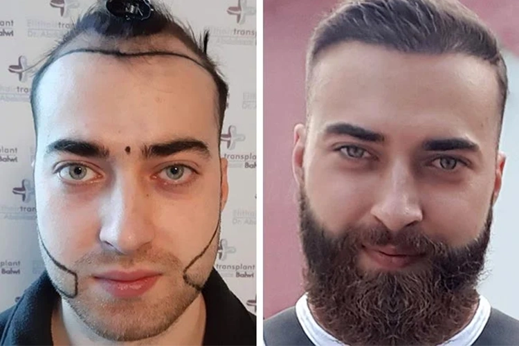 comparaison visuelle montrant une évolution capillaire avec amélioration de la densité et de la ligne frontale